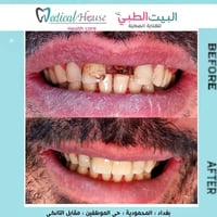 تركيب زركون • تخفيض ٤٠٪ • المحمودية