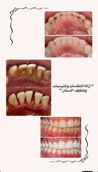 تنظيف اسنان • علاج مجاني • إزالة التكلسات