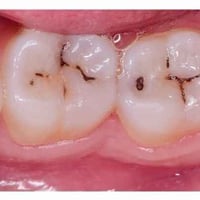 حشوة ضوئية • مجاناً • كلية طب الأسنان