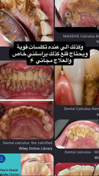 تنظيف اسنان • علاج مجاني • قلع اسنان