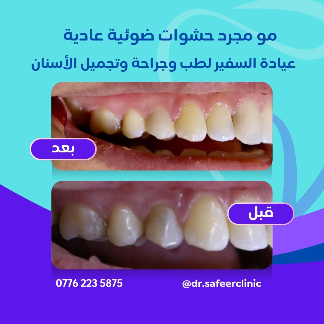 ✨ مو مجرد حشوات ضوئية عادية…
هي عناية بتفاصيل ابتسامتك حتى ترجع أسنانك بشكل صحي وجميل 🤍🦷

من التسوس والتصبغات إلى نتيجة مرتبة وطبيعية ✨
حافظ على أسنانك ولا تنتظر الألم حتى تبدأ العلاج.

📍 عيادة السفير لطب وجراحة وتجميل الأسنان
📞 ***********
📩 للحجز والاستفسار: عـيادة الـسفير

#عيادة_السفير #حشوات_ضوئية #علاج_الاسنان #تجميل_الاسنان #ابتسامة_صحيه

نص مكتوب في الصور:
- مو مجرد حشوات ضوئية عادية
- عيادة السفير لطب وجراحة وتجميل الأسنان
- بعد
- قبل
- ***********
- @dr.safeerclinic
- مو مجرد حشوات ضوئية عادية عيادة السفير لطب وجراحة وتجميل الأسنان بعد قبل *********** @dr.safeerclinic