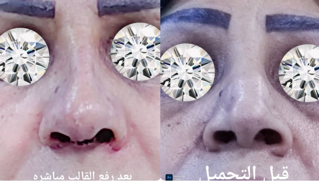 بعد رفع القالب مباشره... تجميل الانف الطبيعي
        ***********

نص مكتوب في الصور:
- قبل التجميل بعد التجميل
- بعد التجميل
- قبل التجميل
- بعد رفع القالب مباشره
