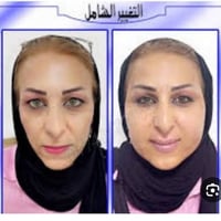 فيلر • تغيير شامل • غير جراحي