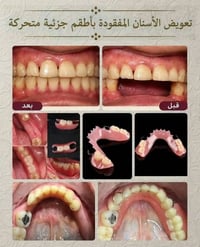 طقم اسنان متحرك • مجانا • بغداد حي القاهرة
