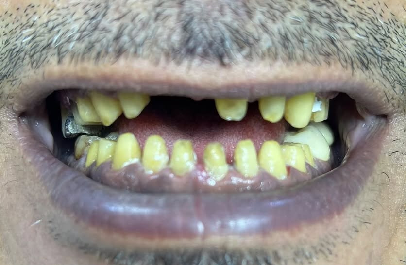 قبل تركيب ابتسامه ايماكس
واثناء العمل
وبعد تركيب الابتسامه
باشرف الطبيب ثائر عباس

📍 متواجدين يومياً طوال أيام الأسبوع:

⏰ من 9 الصبح إلى 12 الظهر
⏰ ومن 2:30 العصر إلى 9:30 بالليل

📞 للتواصل ويانه:

✅ العيادات البشرية: ***********
✅ عيادات التجميل: ***********
✅ عيادات الأسنان: ***********

📍 العنوان:
الناصرية – شارع بغداد، مجاور مدرسة الجواهري الأهلية

#العراق #تجميل #اكسبلور #ترند #explore
