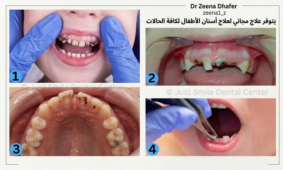 علاج مجاني • أسنان أطفال • يرموك كلية الحكمة