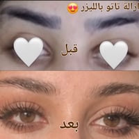 ازالة تاتو بالليزر • قبل بعد • سوق الذهب