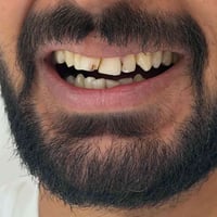تجميل أسنان • مركز سما المناذرة • المناذرة النجف