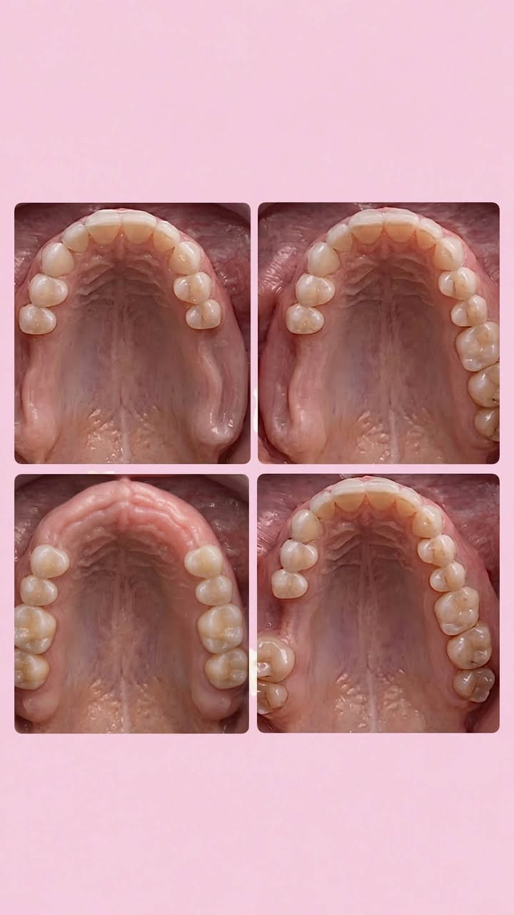 السلام عليكم
علاج اسنان مجاني 
حشوات ضوئية تجميلية 
تنظيف اسنان وازالة التكلسات والتصبغات قلع الاسنان والجذور التالفة 
تعويض الاسنان المفقودة بطقم جزئي متحرك 
الموقع بغداد الكرادة شارع 52 

اذا عندكم وحدة من هذي الحالات الي موجودة بالصور 
تواصلوا ويايه عالواتساب 
***********

نص مكتوب في الصور:
- *********** بغداد الكرادة شارع 52 عيادات جامعة اوروك التخصصية