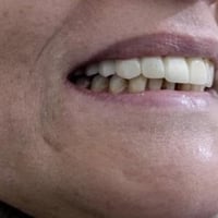 تراكيب اسنان • اسنان اماميه • عيادة حيدر