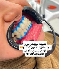 لا توجد تفاصيل  نص مكتوب في الصور: - نتيجه تبييض ليزر بجلسه وحده فرق ش...