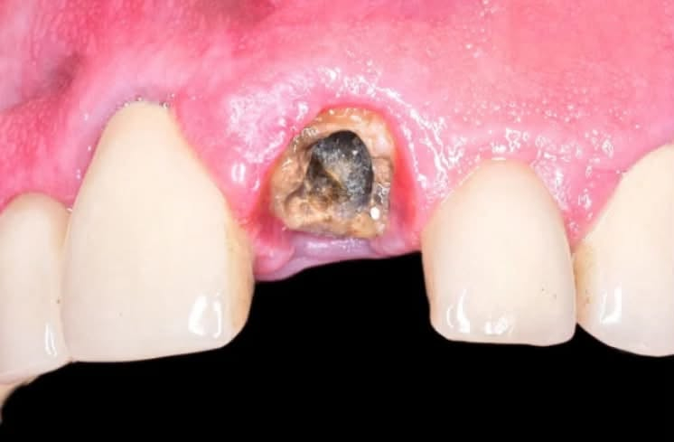 � خدمات علاجية مجانية للفم والأسنان 🦷
تعلن كلية طب الأسنان / جامعة بابل عن توفر خدمات علاجية مجانية بالكامل للفم والأسنان، تُقدَّم تحت إشراف أطباء مختصين.

📞 للحجز والاستفسار: ***********

🔹 الخدمات المتوفرة:

1️⃣ تنظيف الأسنان
2️⃣ أطقم الأسنان الجزئية المتحركة
3️⃣ الحشوات التجميلية   
4️⃣ قلع الأسنان التالفة والجذور المتبقية

📸 نماذج من الحالات والخدمات موضحة في الصور المرفقة.

📍 الموقع:
عيادات كلية طب الأسنان / جامعة بابل
حي الجامعة – الإسكان، مقابل الكراج الموحد

✨ الخدمات مجانية بالكامل وتُجرى تحت إشراف أطباء مختصين

نص مكتوب في الصور:
- عمل حشوات ضوئية تنظيف الأسنان و إزالة التكلسات و التصبغات قلع الأسنان التالفة والجذور المتبقية تعويض الأسنان المفقودة بطقم جزئي متحرك
- THE SIX CLASSES CLASS I Pits and fissures of molars, premolars, and lingual pits of anterior teeth. CLASS II Proximal surfaces of posterior teeth. CLASS III Proximal surfaces of anterior teeth without involving the incisal edge. CLASS IV Proximal surfaces of anterior teeth involving the incisal edge. CLASS V Cervical third of the facial or lingual surfaces of any tooth. CLASS VI OR Incisal edges of anterior teeth and cusp tips of posterior teeth.
