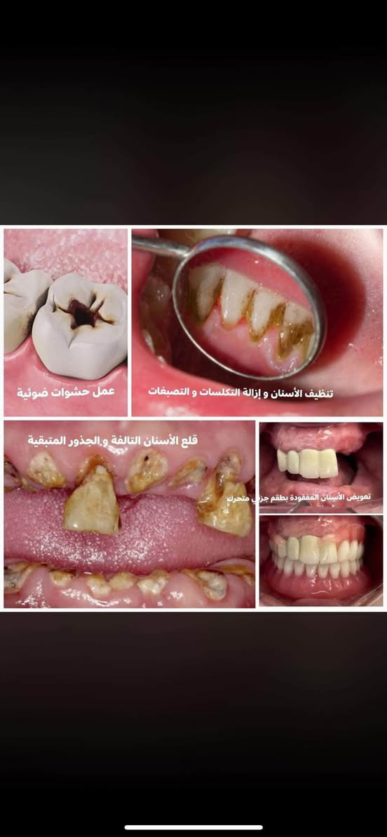 � خدمات علاجية مجانية للفم والأسنان 🦷
تعلن كلية طب الأسنان / جامعة بابل عن توفر خدمات علاجية مجانية بالكامل للفم والأسنان، تُقدَّم تحت إشراف أطباء مختصين.

📞 للحجز والاستفسار: ***********

🔹 الخدمات المتوفرة:

1️⃣ تنظيف الأسنان
2️⃣ أطقم الأسنان الجزئية المتحركة
3️⃣ الحشوات التجميلية   
4️⃣ قلع الأسنان التالفة والجذور المتبقية

📸 نماذج من الحالات والخدمات موضحة في الصور المرفقة.

📍 الموقع:
عيادات كلية طب الأسنان / جامعة بابل
حي الجامعة – الإسكان، مقابل الكراج الموحد

✨ الخدمات مجانية بالكامل وتُجرى تحت إشراف أطباء مختصين

نص مكتوب في الصور:
- عمل حشوات ضوئية تنظيف الأسنان و إزالة التكلسات و التصبغات قلع الأسنان التالفة والجذور المتبقية تعويض الأسنان المفقودة بطقم جزئي متحرك
- THE SIX CLASSES CLASS I Pits and fissures of molars, premolars, and lingual pits of anterior teeth. CLASS II Proximal surfaces of posterior teeth. CLASS III Proximal surfaces of anterior teeth without involving the incisal edge. CLASS IV Proximal surfaces of anterior teeth involving the incisal edge. CLASS V Cervical third of the facial or lingual surfaces of any tooth. CLASS VI OR Incisal edges of anterior teeth and cusp tips of posterior teeth.