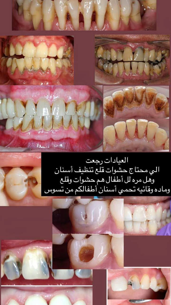 بغداد باب المعظم • علاج أسنان مجاني • قلع وحشوات