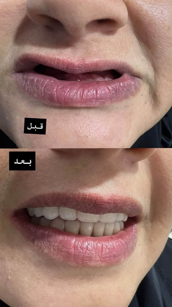 النجف الاشرف / شارع الإسكان
قرب مستشفى الزهراء
علما العلاج مجاني
للحجز مراسلت الواتساب لطفاً
***********

نص مكتوب في الصور:
- تم فتح الحجز في عيادات الكفيل النجف الاشرف / شارع الإسكان / قرب مستشفى الزهراء للحالات الاتيه: تنظيف الأسنان وأزالة التكلات القويه (الي عدهم التهاب باللثه وتورم ونزف) قلع الأسنان التالفة والجذور المتبقية واسنان العقل والقلع الجراحي علاج اسنان الاطفال (قلع حشوات وفلورايد وقائي) تعويض الاسنان بطقم كامل متحرك العلاج بالتقويم لبعض الحالات علاج أمراض وتقرحات الفم واللثة حشوات ضوئية تجميليه لجميع الاسنان علما العلاج مجاني للحجز *********** الدكتورة شيرين علي حسين
- قبل
- بعد