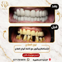 زيركون • ابتسامة • البصرة