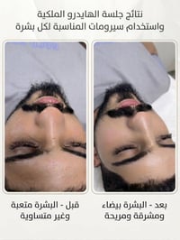 ✨ جلسة الهايدرو الملكية ✨ عيادة اجنادين دكتور مؤيد محمد علي الثعالبة ا...