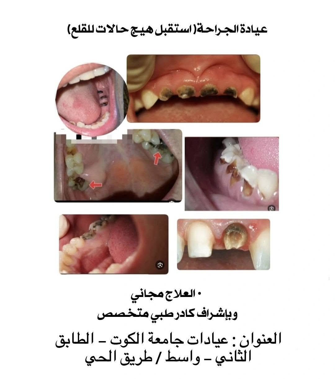 علاج مجاني • جامعة الكوت • حشوات تجميلية