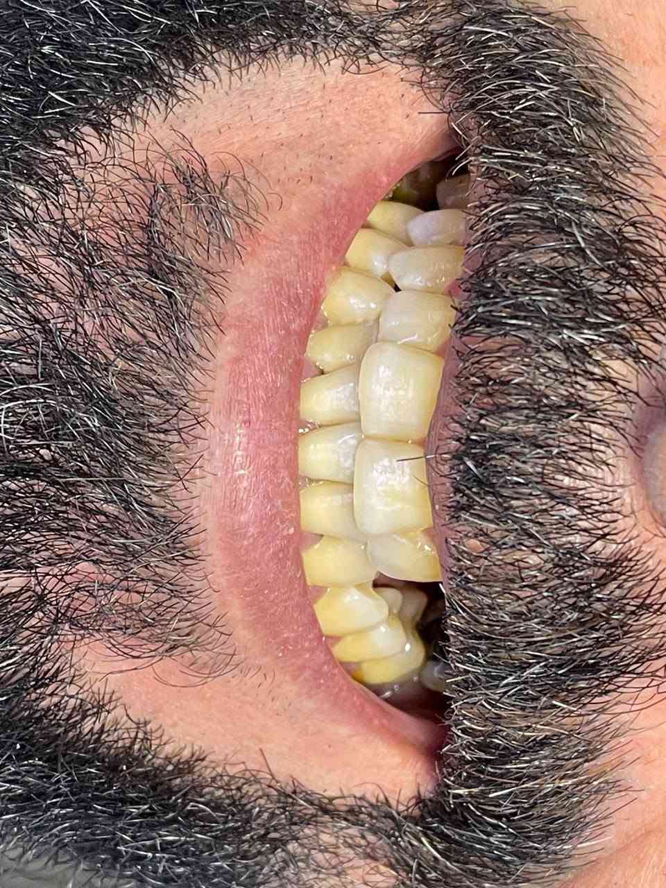 مراجعنا كان فاقد اكثر من سن.وبعد قراءة الأشعة ثلاثيه الأبعاد كانت خطه العلاج زراعة عظم بعدها زراعه ٣ أسنان ولإن الابتسامة ما تنتظر .سوينه تخم متحرك كحل مؤقت حتى الحلول المؤقته في عياده الاتقان متقنه

متواجدين يومياً من الساعه 4العصر وحتى الساعه 9مساءً

عياده الاتقان لزراعة وتقويم الاسنان

للحجر والاستفسار الاتصال ***********
