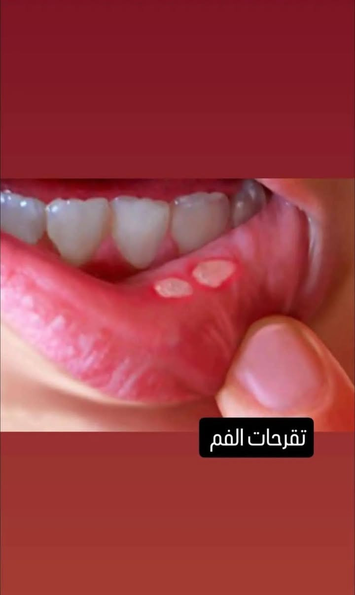 علاج مفصل الفك • بوتوكس • تقرحات الفم
