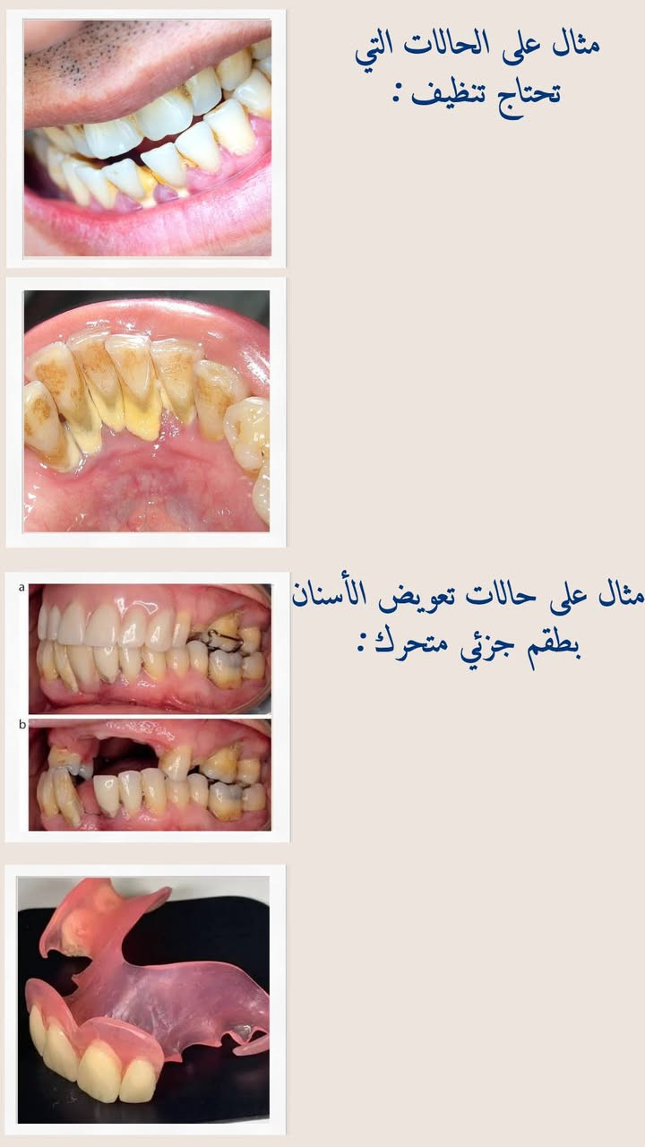 علاج مجاني • قلع أسنان • طقم جزئي