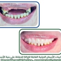 علاج أسنان • الرمادي داخل الكلية • اسعار رمزية