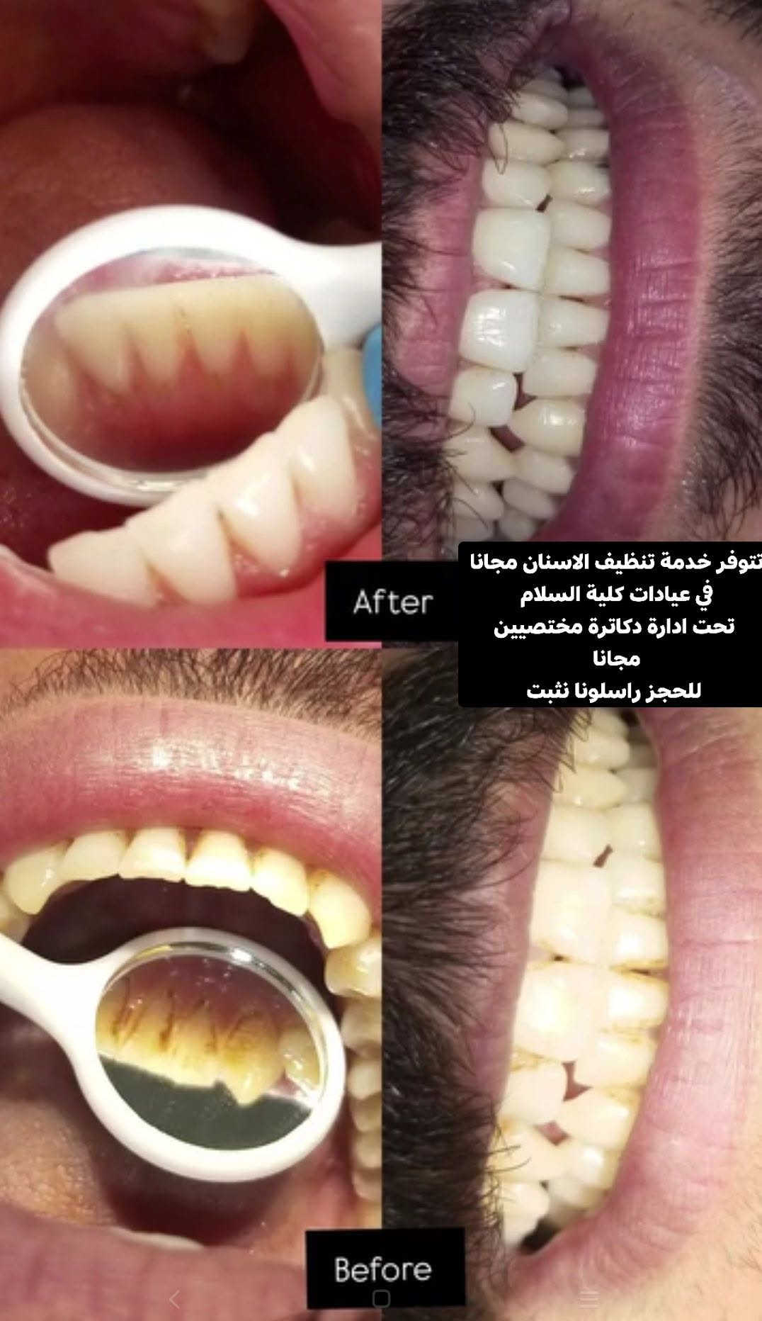 تنظيف الاسنان • مجانا • عيادات كلية السلام