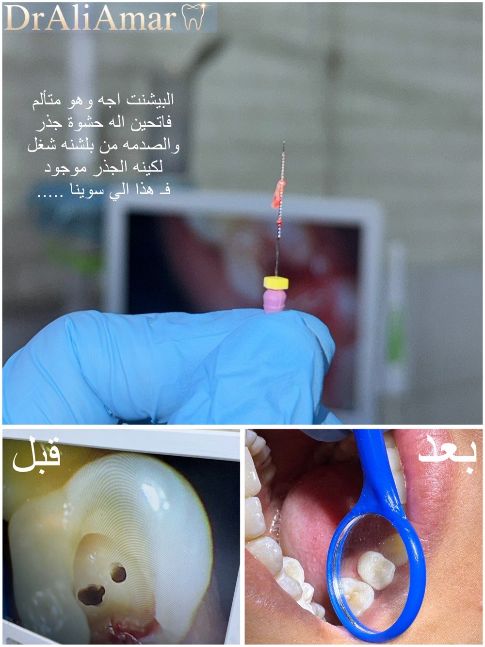 التنظيف لأول جلسة مجاني 🦷🤍
والذي يميزنا عن باقي العيادات نستقبل حالات الطوارئ لمدة 24 ساعة 
ورقم الطوارئ وللحجز والاستفسار : ***********
الموقع📍:الحسينية_الراشدية / مقابل الحاج الحسن ومجاور لمصور الزهور
#dentist #doctor #الحسينية #مطعم_الامير #طب_اسنان