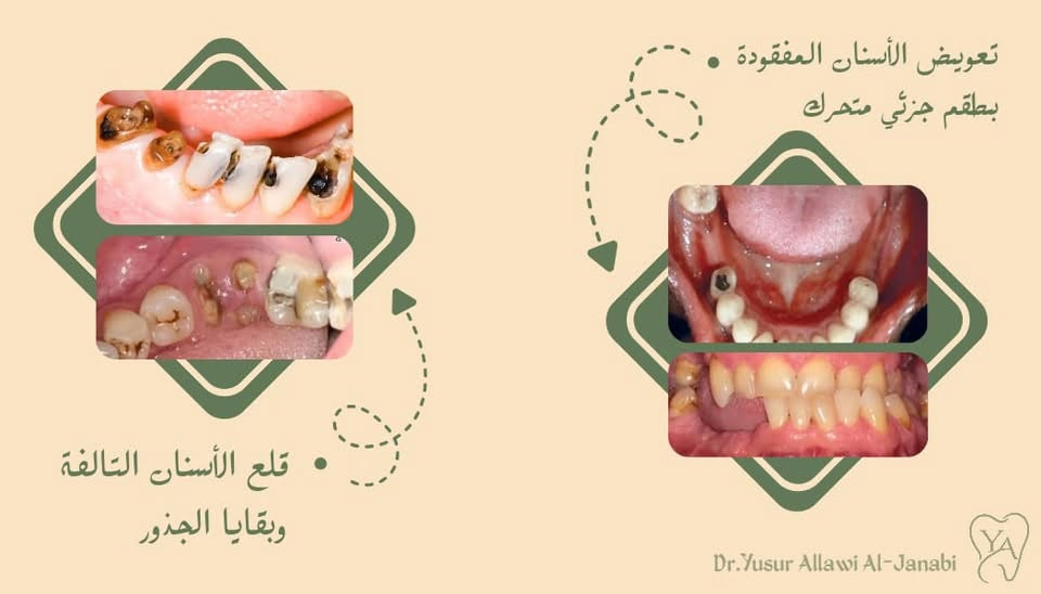 أي احد يحتاج علاج أسنان (حشوة -قلع-تعويض أسنان-تنظيف) يتواصل ويايه
وتشرفونا بحضوركم 🤍

- والعلاج مجاني بالكامل -

الموقع: الاعظمية - مجاور المقبرة الملكية 
العيادات التعليمية لكلية طب الأسنان -الجامعة العراقية

للإستفسار - التواصل على حساب الإنستغرام
أو معرف التليغرام ♥️
حساب الإنستغرام : dr.y_aljanabi
معرف التليغرام : YusurA_58
او التواصل على الواتساب عبر الرقم 
***********

الصور أمثلة على الحالات الي نشتغلها:

نص مكتوب في الصور:
- طبيبة الأسنان د. يُسر علاوي الجنابي - إبتسامتك ، أولويتنا -
- د. يُسر علاوي الجنابي
- فحص وتشخيص الأسنان
- تنظيف الأسنان وإزالة التّكلسات
- حشوات ضوئيّة وتجميليّة
- تعويض الأسنان المفقودة بطقم جزئي
- قلع الأسنان التالفة وبقايا الجذور
- العلاج مجاني وبإشراف أطباء مختصين
- YA
- YusurA_58
- Dr.y_aljanabi
- العيادات التعليمية لطب الأسنان - الجامعة العراقية
- الاعظمية - قرب المقبرة الملكية
- تنظيف الأسنان وإزالة التكلسات
- حشوات ضوئية وتجميلية لتسوسات الأسنان
- Dr. Yusur Allawi Al-Janabi
- تعويض الأسنان المفقودة بطقم جزئي متحرك قلع الأسنان التالفة وبقايا الجذور Dr.Yusur Allawi Al-Janabi