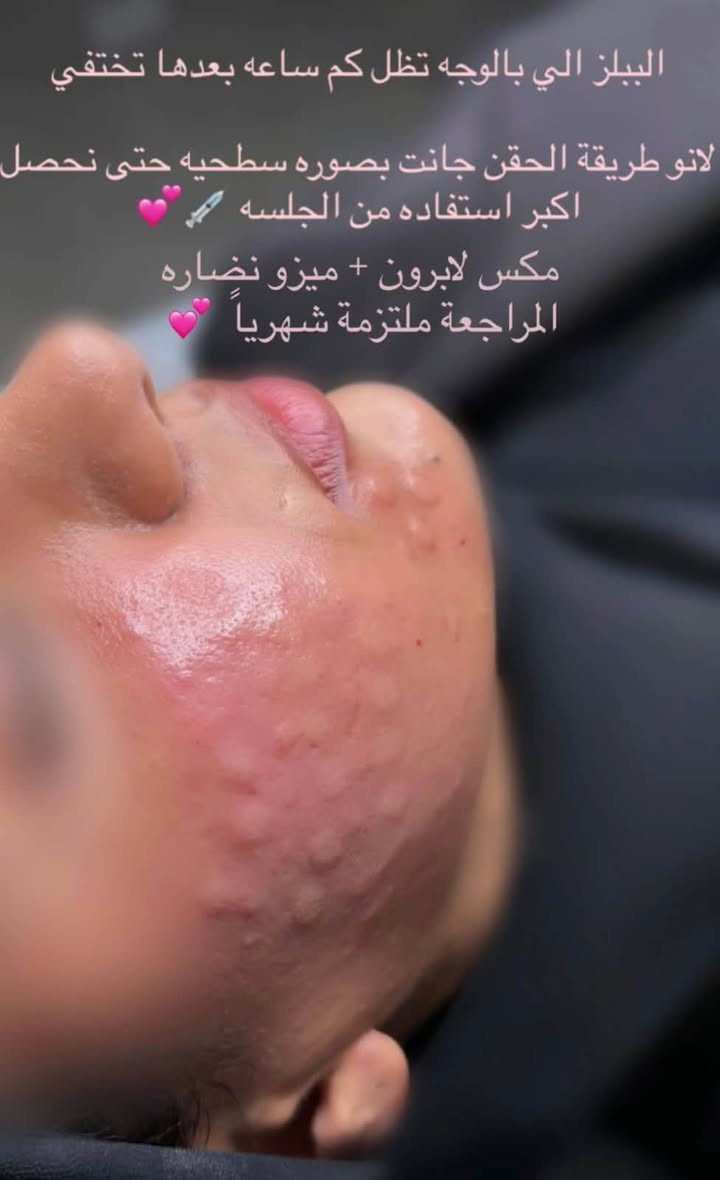 هواي دزيتولي على عروض
فرحة الزهرة وموسم اعراس وحفلات ونريد نفرح تدللون

بعد مانزلت ان توفرت ماشاءالله المسجات متوقفت💗 بس هالمرة الكمية تكفي الكل ان شاءالله وكلكم تلحكون تسوون تغييرات حلوة والعروض مستمره بلشت من اليوم 

 خلص العروض صارت جاهزة 
ومراح تتكرر ابداً هيج عروض لان بيها جلسات فري 🎁 تستفادون منها كلش هواي خصوصا الي يحتاجون عدة جلسات 🎁💗

بس لخاطرر تفرحون بمناسباتكم وتسوون كلشي عاجبكم

والمهم المواد مسجلة ومفحوصه من وزارة الصحة 
العروض تكدرون تراسلونا على الدايركت او على الواتساب مسج
***********

العنوان المسيب شارع البلدية تواجدي يكون ايام معينة بالمسيب وباقي الايام كلها بغداد لذلك يرجى الحجز قبل الحضور 💗🎁
