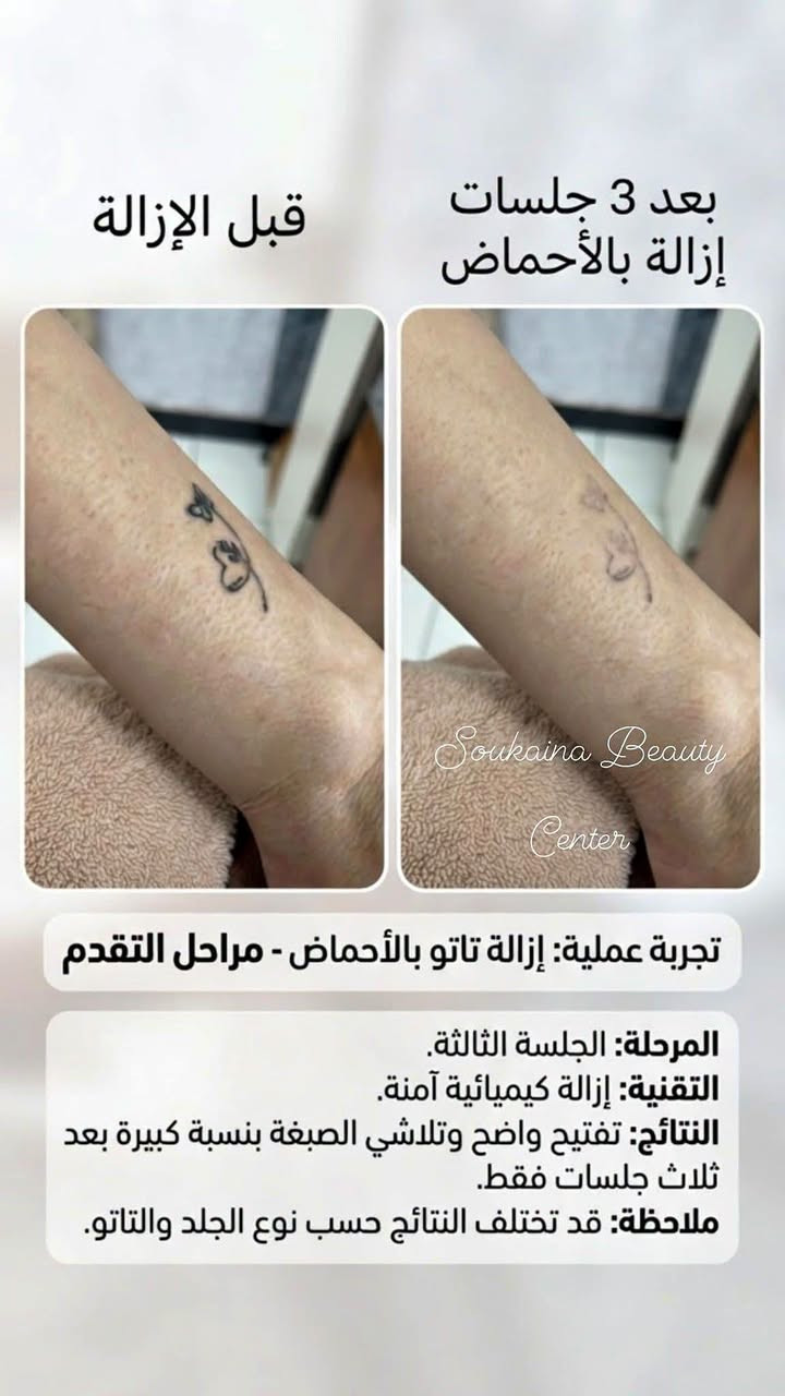 إزالة تاتو • ٣ جلسات • فيريموفل نانو