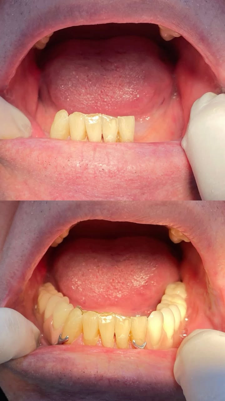 ابتسامتك تستحق عناية تليق بها
نقدّم لكم خدمات طب الأسنان في عيادات طب الأسنان - جامعة الكوفة، باهتمام ودقة وحرص على راحتكم.
خلف كلية الفقه
نظيف الأسنان وازالة التكلسات
حشوات تجميلية
تعويض الأسنان المفقودة
قلع الأسنان التالقة
والجذور المتبقية
***********
n.our.1_

نص مكتوب في الصور:
- drgabrielwahyudi