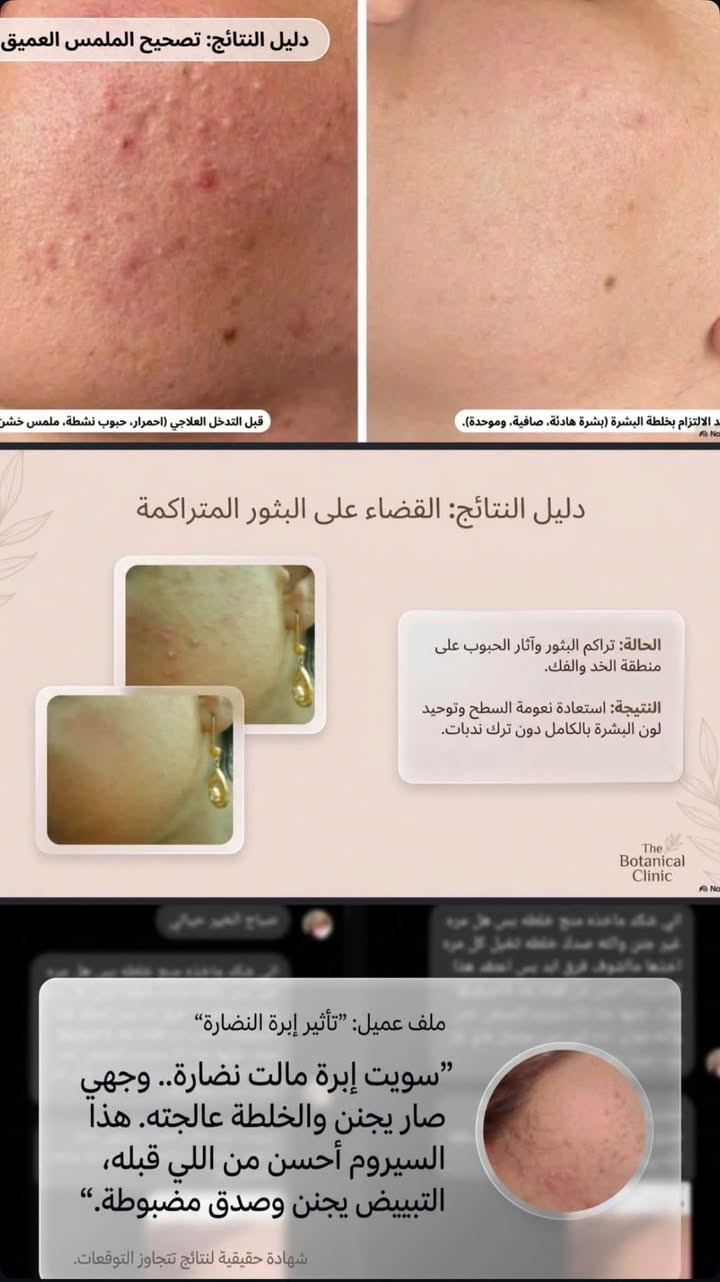 ‎بنات اقسم بالقرآن  وع كل حرف  اكوله وان شاء الله  
‎بعافيتي وبصحتي ا🤩ذا اغشكم بنات اسوي زيت للشباب وللببنات شعر يفور فورررررر عليه انسي بعد شي حرك من صبغ انسي بعد  قصير انسي شي تساقط لي دتطلب علبة دترجع نوب تاخذ بنات يموووت انصحكم بي  ثقو بالله ددمرون شعركم بالمنتجات بنات هذا جربو وادعولي واني بيدي اسوي الخلطة وتوصيل مجاني كذلك واسوي خلطه للوجه اكسر بيها ابر تبيض ونضارة وشد الله شاهد على كلامي

نص مكتوب في الصور:
- خلطة الكولاجين للبشرة - نضارة وتبييض
- فوائدها تخبل:
- - تبيض البشرة وتنطي نضارة ولمعة من اول استعمال
- - تشيل الكلف والتصبغات وتوحد اللون
- - تشد الوجه وتشيل التجاعيد والخطوط الرفيعة
- - ترجع الشباب للبشرة وتحارب الشيخوخة
- - ترطب بعمق وتنطي لمعة صحية تجنن
- - بيها كولاجين صافي يغذي البشرة ويجددها
- استعملهاها: بالليل على بشرة نظيفة، شوية منها ودلكيها لحد ما تمتصها البشرة
- للحجز والاستفسار
- ***********
- منتج طبيعي • آمن للبشرة
- Supplied
- BEFORE AFTER
- دليل النتائج: تصحيح الملمس العميق
- قبل التدخل العلاجي (احمرار، حبوب نشطة، ملمس خشن)
- دليل النتائج: القضاء على البثور المتراكمة
- الحالة: تراكم البثور وآثار الحبوب على منطقة الخد والفك.
- النتيجة: استعادة نعومة السطح وتوحيد لون البشرة بالكامل دون ترك ندبات.
- The Botanical Clinic
- ملف عميل: "تأثير إبرة النضارة"
- "سويت إبرة مالت نضارة.. وجهي صار يجنن والخلطة عالجته. هذا السيروم أحسن من اللي قبله، التبييض يجنن وصدق مضبوطة."
- شهادة حقيقية لنتائج تتجاوز التوقعات.