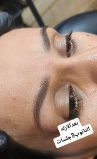 ازالة تاتو • ٣ جلسات • السماوه الحسين