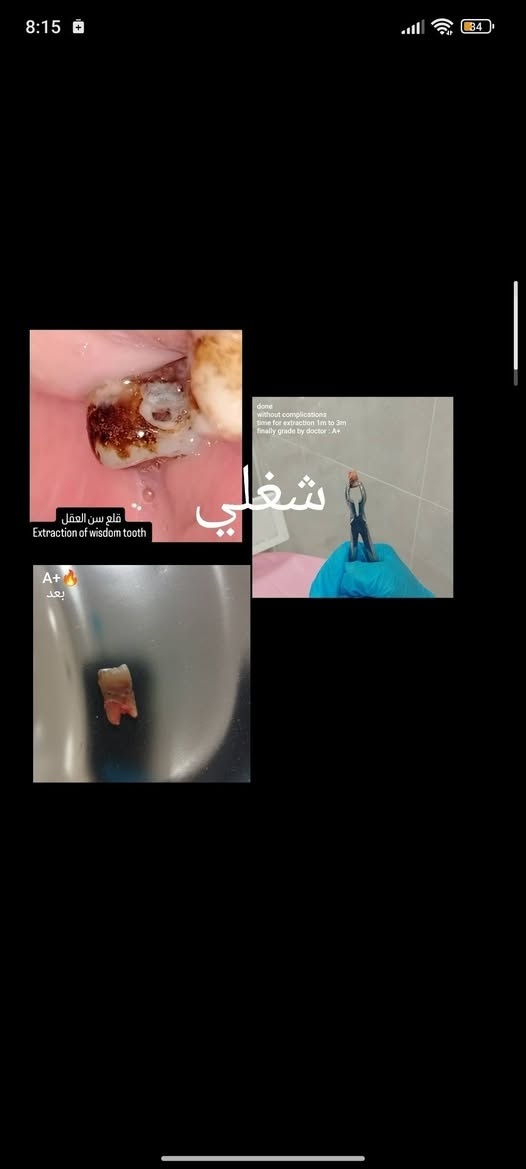 علاج مجاني
السلام عليكم ورحمة الله وبركاته للمرضى الاعزاء يتوفر لدينا :-
قلع سن و بقايا الجذور.
حشوات اسنان. 
طقم اسنان جزئي أو كامل.
 تنظيف الاسنان من التكلسات.
تقويم اسنان.
علاج مفصل الفك.
تشخيص امرض الفم.
علاج صرير و طحن الاسنان اثناء النوم بستخدم الحارس الليلي.

مجاني في  عيادات جامعة النور التخصصية لطب الاسنان بإشراف الدكاترة المتخصصين في طب الاسنان الاستفسارات والأسئلة العامة الاتصال على الرقم التالي :
***********
الدكتور واثق عبدالله حسن

نص مكتوب في الصور:
- 8:15 34 قلع سن العقل Extraction of wisdom tooth A+ بعد done without complications time for extraction 1m to 3m finally grade by doctor : A+ شغلي
- قبل شغلي بعد