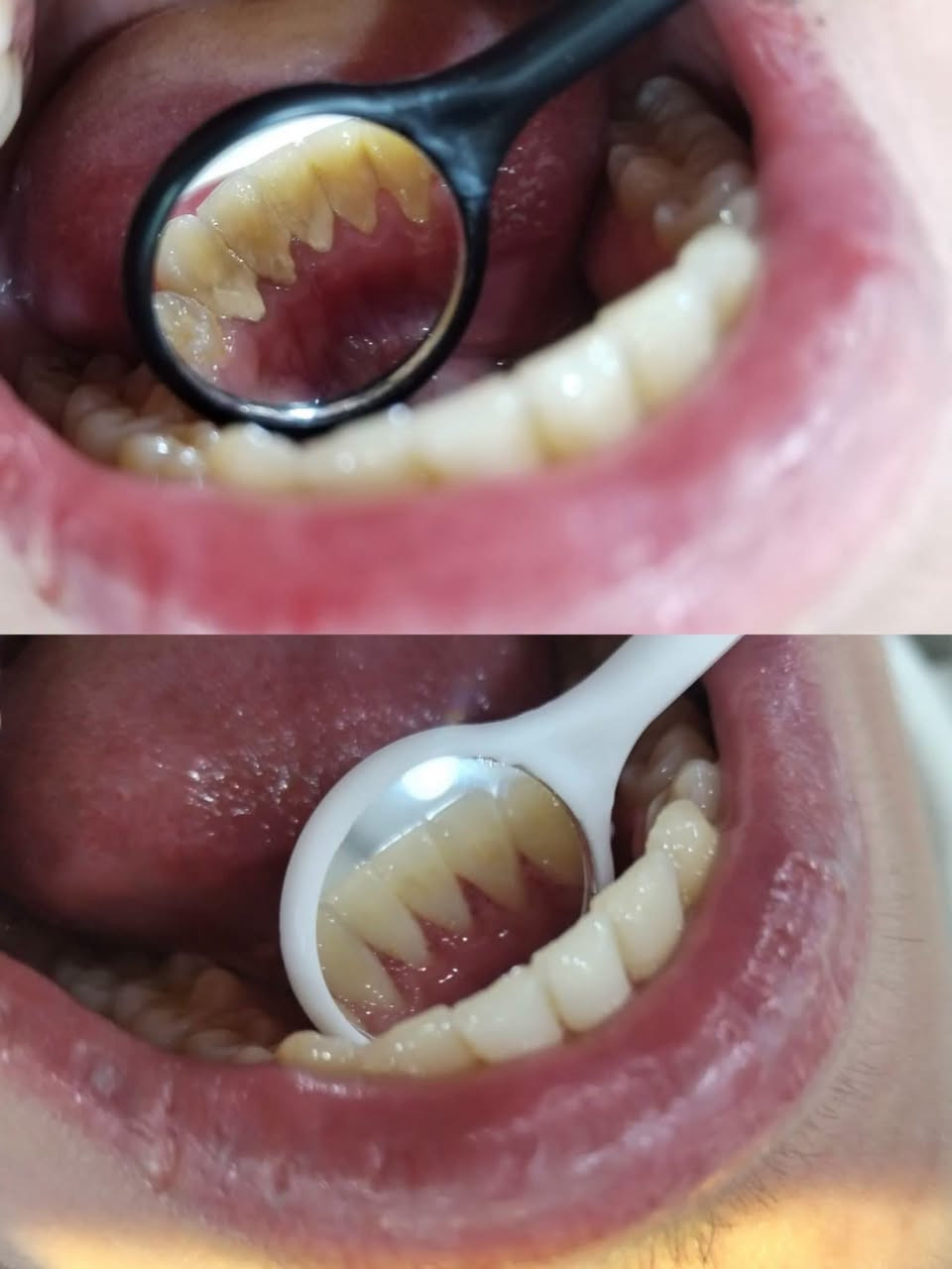 على بركة الله نعاود استقبال الحالات التالية في عيادات جامعة الحلة 🦷
-الحشوات الضوئية (الحشوة البيضاء)
_تنظيف الاسنان وازالة التكلسات 
_قلع الاسنان التالفة والجذور المتبقية
_تعويض الاسنان المفقودة بطقم كامل
_قلع وحشوات ومعالجة اسنان الاطفال

🔴العلاج بشكل شبه مجاني 

الموقع🔻 :شارع اربعين،مجاور صيدلية سلامتك

للحجز والاستفسار📞: ***********

نص مكتوب في الصور:
- Before