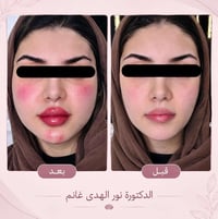 فلر • تجميل غير جراحي • الديوانية