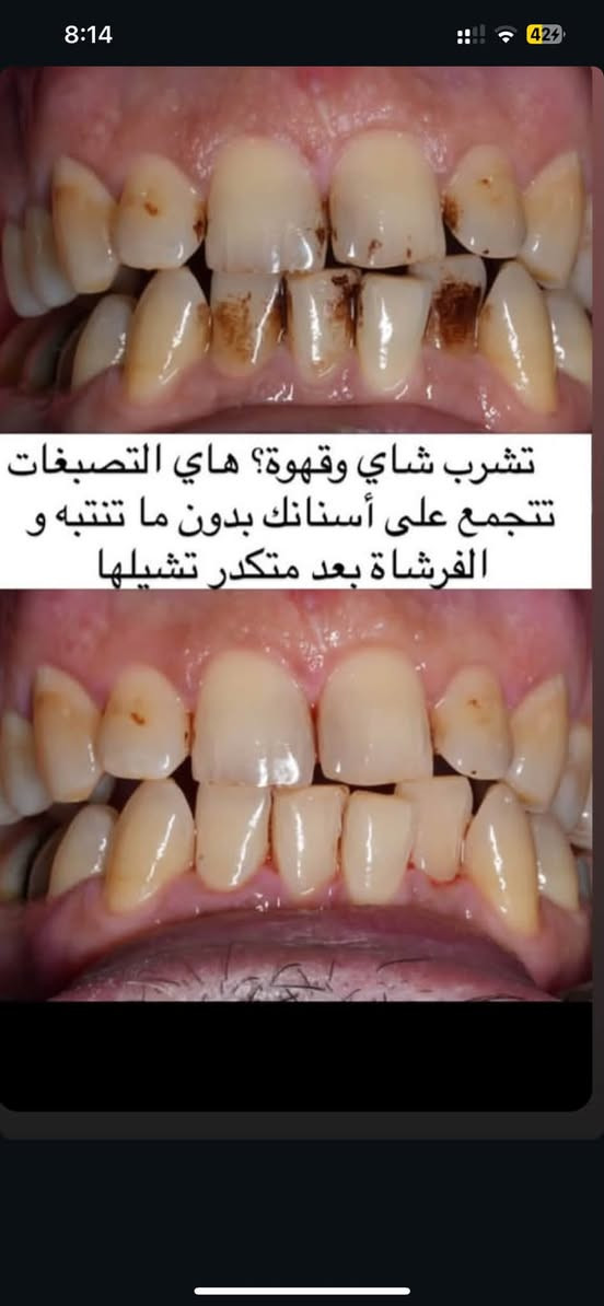تنظيف أسنان • جامعة الشرق الاوسط • الاثنين