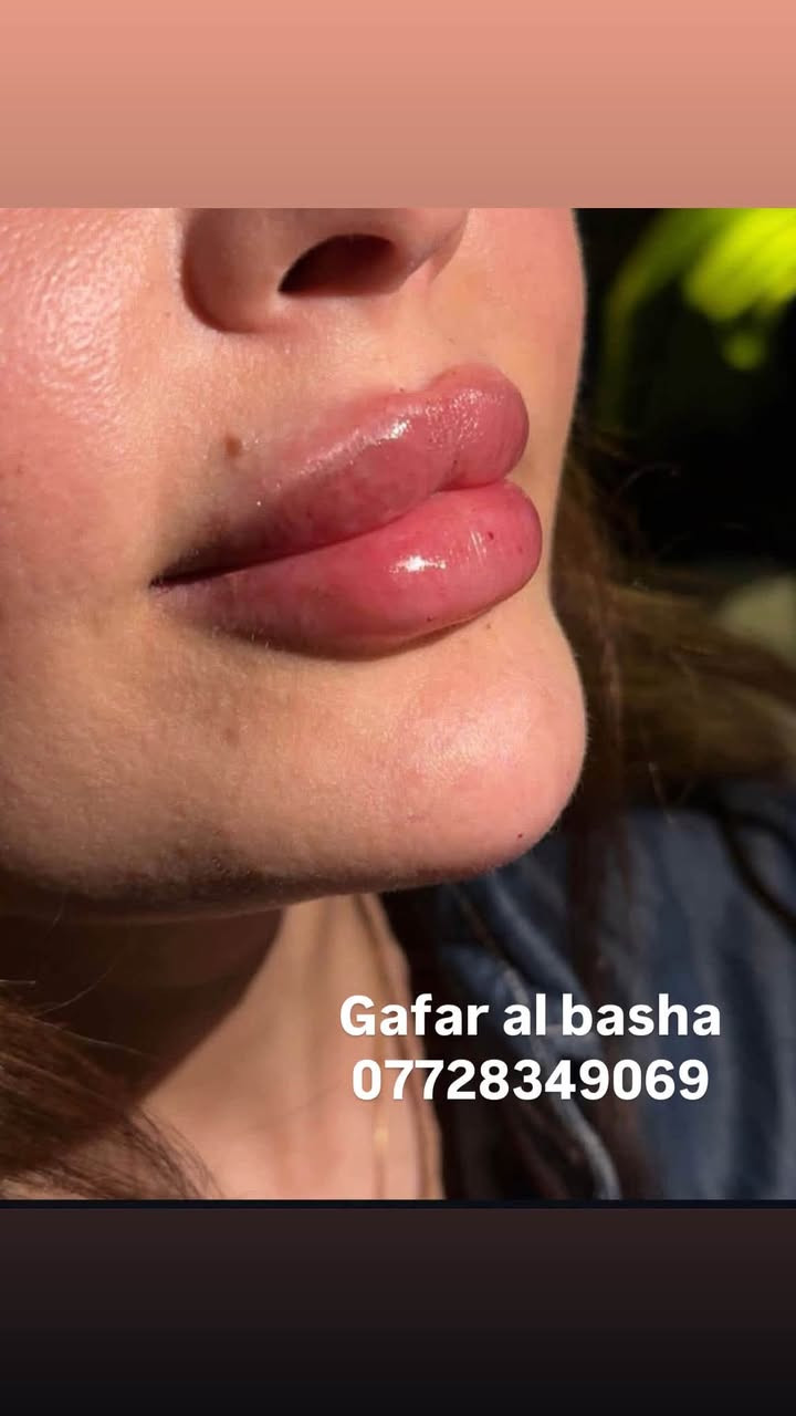 عروض قسم العيادة💉🔥
لشهر 9 فقط😍
قسم الفلر : 👇🏻
🌷فلر امريكي ٧٥ الف فقط
🌷فلر كوري  ٧٥ الف
🌷فلر سوفي ديرم الماني ٨٠ الف 
🌷فلر جوفيديرم الفرنسي ٨٠ الف
🌷فلر سويسري٩٠ الف
🌹 فيلر ايطالي 100
🌸🌸🌸🌸

عرض التغيير الشامل ( شفة + وجنات + تكساس ) 350 الف فقط
Vip اب 600 الف 
🌸🌸🌸🌸

🌷ابره العروسه ١٢٥ الف بدل ال١٧٥
🌷بوتوكس كامل ١٠٠  الف بدل ال١٥٠ الف
🌷بوتوكس عدد شخصين اب١٥٠ الف
🌸🌸🌸🌸

قسم البشرة :
🌷ميزو تصبغات  50 الف
🌷ميزو هالات 50 الف
🌷هايدروفيشال  25 الف
🌷 ميزو تبييض 50 الف 
🌷علاج التصبغات البشرة 50 الف وب 75 و100 حسب النوع
🌷تنظيف البشرة + ميزو تبييض مع بلازما ٧٥ الف
🌷تنظيف البشرة الملكي ٥٠ الف الف
🌷بلازما + خلايا جذعية ٤٠ الف

 📆ايام الدوام : طيلة ايام الاسبوع
⏰وقت دوام الدكتور و الدكتورة: ‎من ١٢ مساءا  - الى ال١٠ مساءا  
📲للحجز والاستفسار 
***********💎

العنوان/ العماره مغربه

#تجميل #جمال #مكياج #تسريحات #صالون #مناكير #ميك_اب #صبغات #تساريح #ازياء #نقش #عدسات #فساتين_عرايس #حنه #ستايل #رشاقه #فاشن #عروس #موضة #لیزر #كونتور #مشغل #فساتين_سهرة #اناقه #فساتين_زفاف #0
