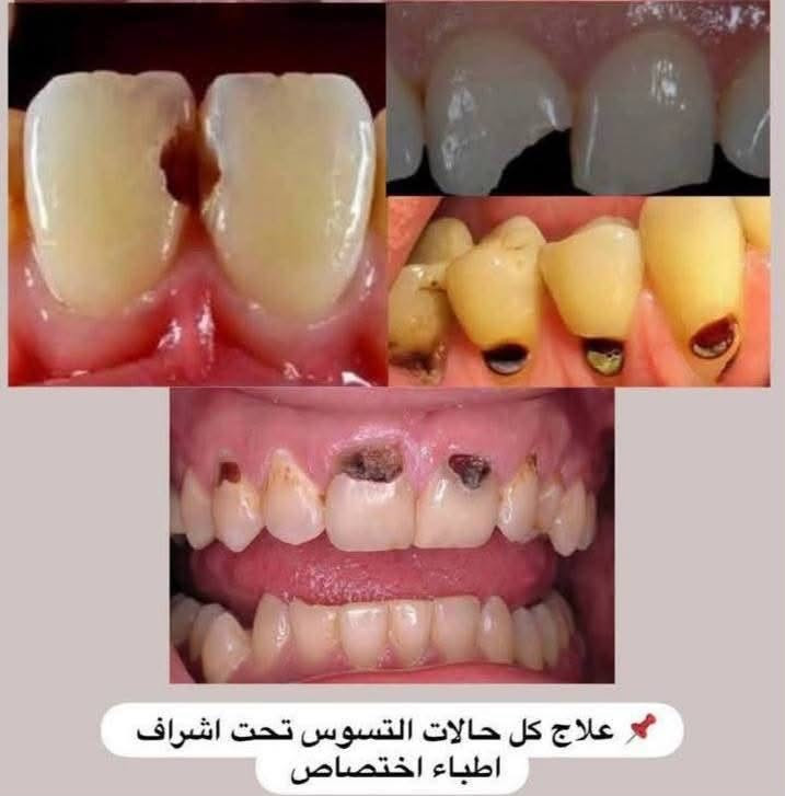 فحص علاج مجاني • تنظيف حشوات قلع • طريق حلة-نجف