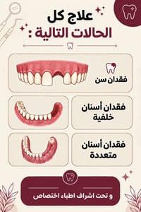 طقم اسنان جزئي • جامعة بابل • تحت اشراف اختصاص