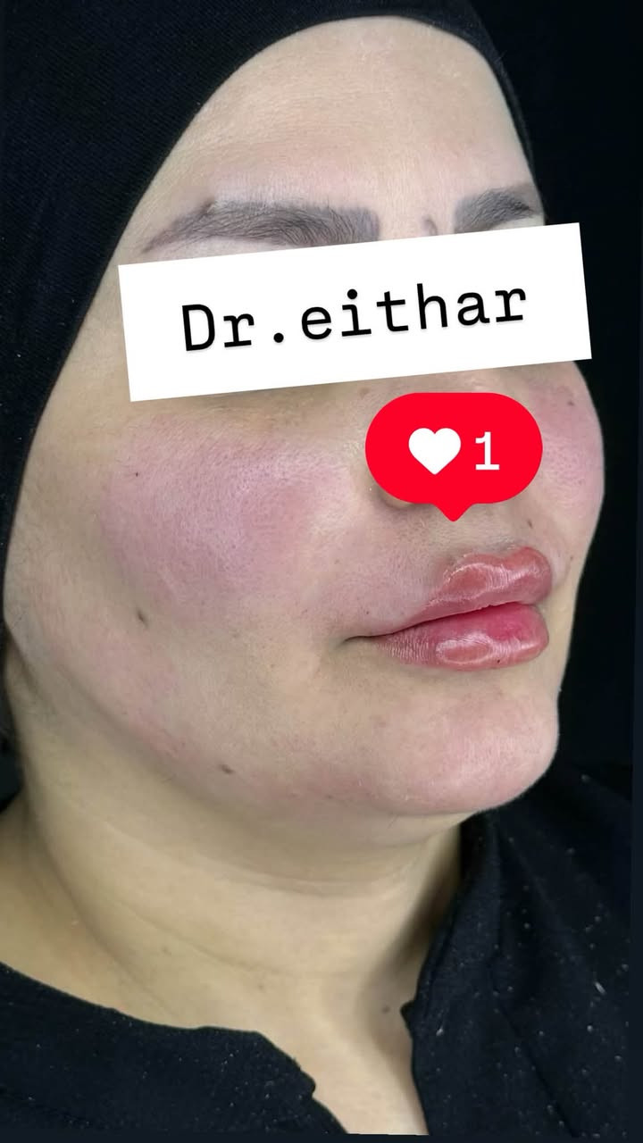 شد لفتنك الوجه بالمحفزات  وفلر شفه  بالفلر الايطالي 🔥🔥🔥
عروووض للكادر التدريسي والخريجات والموظفات والعروسات  ثبتتهه الكم بالستوري بالهايلايت وببوست اعلى الصفحة ✨✨

د.ايثار سامي عبد الامير
واسط الكوت الهوره مجمع القبطان طابق اول 

الحجز***********

نص مكتوب في الصور:
- Dr.eithar 1
