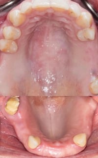طقم أسنان جزئي • علاج مجاني • مدينة الطب
