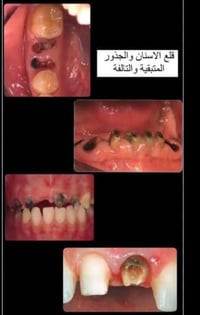 مجاني • قلع أسنان • جامعة الكوفة
