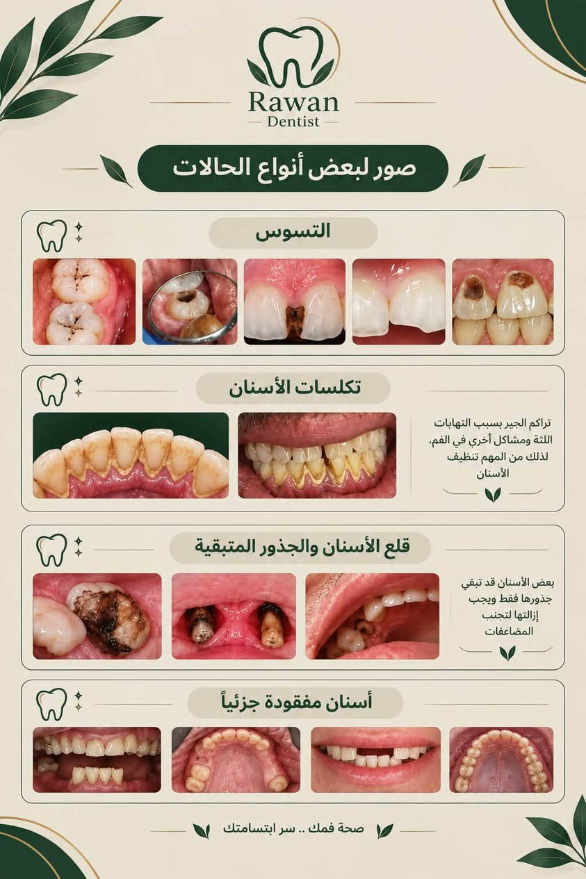 للاستفسار واتساب 
***********

نص مكتوب في الصور:
- Rawan Dentist صور لبعض أنواع الحالات التسوس تكلسات الأسنان تراكم الجير بسبب التهابات اللثة ومشاكل أخري في الفم، لذلك من المهم تنظيف الأسنان قلع الأسنان والجذور المتبقية بعض الأسنان قد تبقي جذورها فقط ويجب إزالتها لتجنب المضاعفات أسنَان مفقودة جزئياً صحة فمك .. سر ابتسامتك