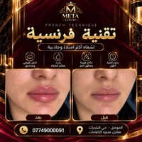 تقنية فرنسية • شفايف ممتلئة • ميتا لاكجري سنتر