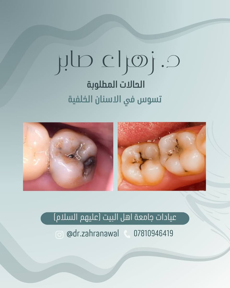 العلاج مجاناً 🤍
إذا كانت حالتكم مطابقة للحالات المطلوبة أو لديكم استفسار، يمكنكم التواصل معي عبر الخاص أو الانستغرام أو رقم الهاتف الموجود في الكارت.

أهلاً وسهلاً بكم، ونسعد بخدمتكم.

نص مكتوب في الصور:
- د. زهراء صابر
- فحص الفم والاسنان
- قلع الاسنان والجذور المتبقية
- تنظيف الاسنان وازالة التكلست
- عمل الحشوات الضوئية (تجميلية)
- تعويض الاسنان المفقودة بطقم جزئي
- عيادات جامعة اهل البيت (عليهم السلام)
- @dr.zahranawal
- ***********
- علماً العلاج مجاناً
- الحالات المطلوبة
- تمبغات او تكلسات حول الاسنان
- @dr.zahranawal ***********
- د. زهراء صابر الحالات المطلوبة تسوس في الاسنان الخلفية عيادات جامعة اهل البيت (عليهم السلام) @dr.zahranawal ***********
- تسوس او كسر في الاسنان الأمامية
- د. زهراء صابر الحالات المطلوبة بقايا الجذور والاسنان التالفة والقلع لغرض التقويم عيادات جامعة اهل البيت (عليهم السلام) @dr.zahranawal ***********