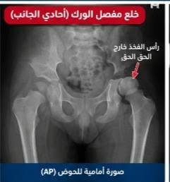 خلع الورك الولادي • سونار أطفال • عيادة العامل