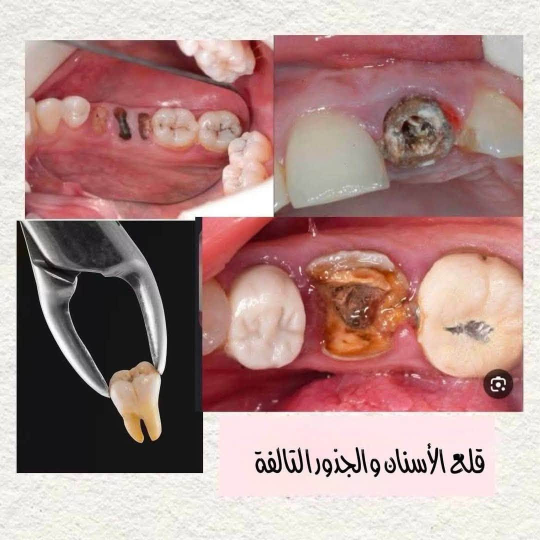 اذا عندك وحدة من هاي الحالات ف الحل عندي والعلاج مجاني 🤩🤩
نستقبلكم في عيادات جامعة الاسراء لطب الأسنان 

نقدم الخدمات العلاجية الآتية : 

-معالجة التسوس بحشوات ضوئية تجميلية

- قلع الأسنان المتضررة جدا وبقايا الجذور 

-تنظيف الأسنان وإزالة التصبغات والتكلسات 

-تعويض الأسنان المفقودة بطقم جزئي متحرك

العلاج مجاني بالكامل وتحت إشراف أطباء إختصاص. 

العنوان : بغداد - الكرادة - ساحة الاندلس 

للحجز والإستفسار واتس آب : ***********

نص مكتوب في الصور:
- تنظيف وازالة التصبغات
- قلع الأسنان والجذور التالفة
- علاج تسوس الاسنان بحشوات تجميلة
- BEFORE
- تعويض اسنان
- طقم متحرك