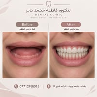 مجاني • طقم اسنان كامل • الكراده